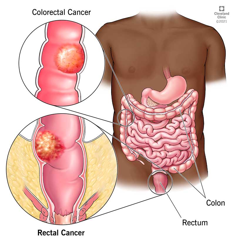 Cáncer de colon