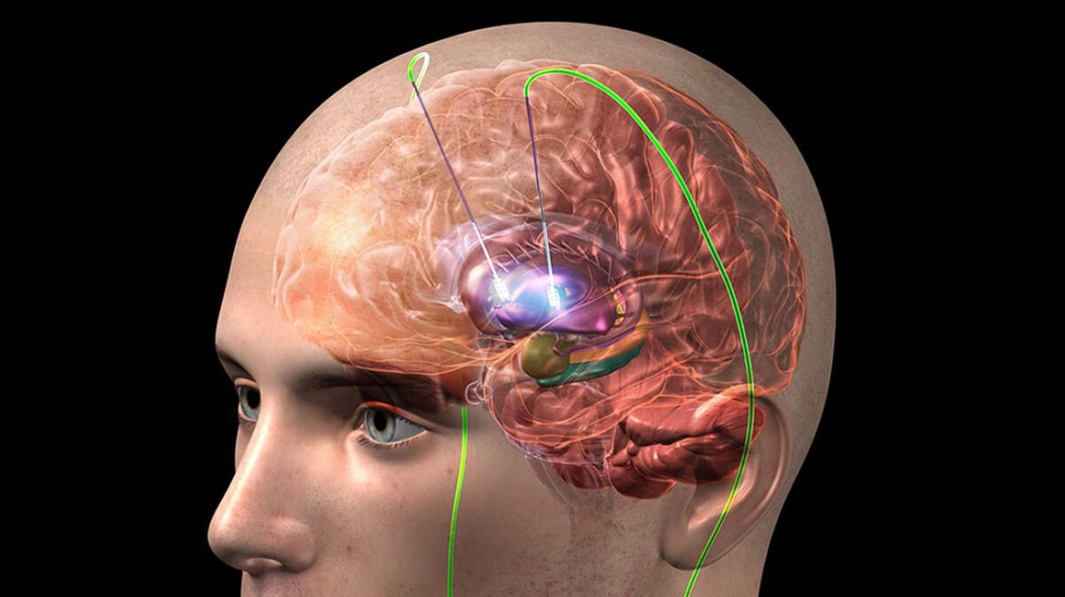 Durante la estimulación cerebral profunda, se implantan electrodos en el cerebro,
