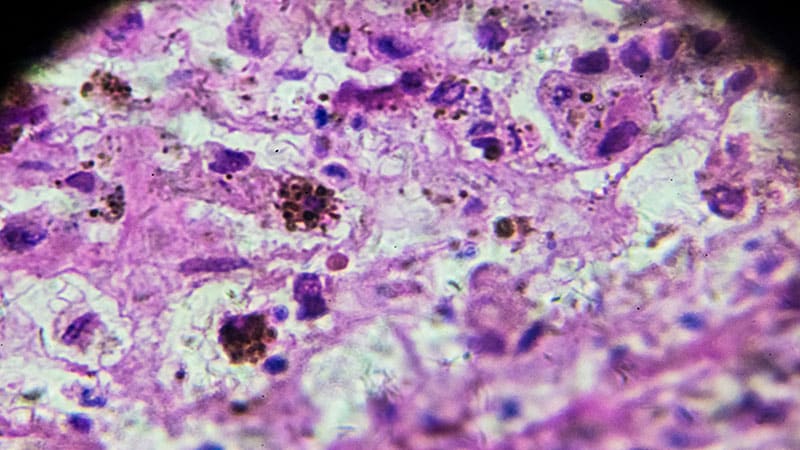 Melanoma biopsy under microscopy zoom in different regions