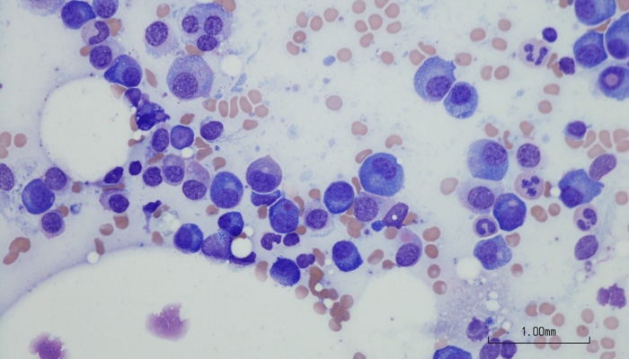 Microscopic photo of a professionally prepared slide demonstrating Plasma cell myeloma from bone marrow aspirate. Wright Giemsa stain.