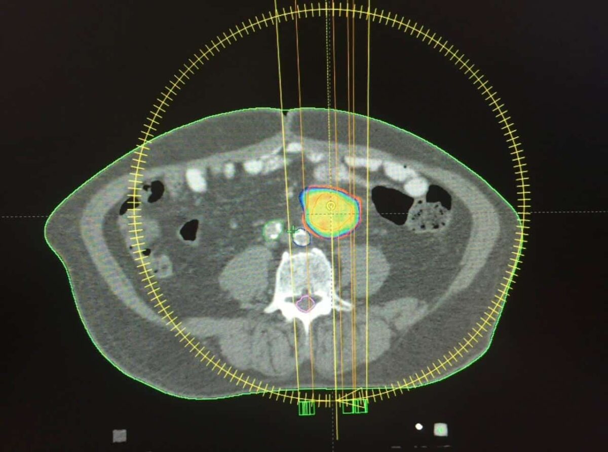 Radiocirugía intracraneal