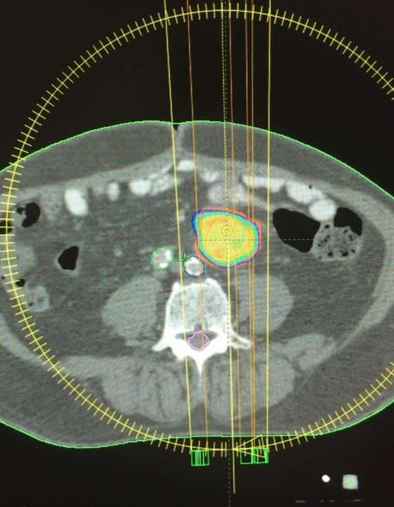 Radiocirugía intracraneal