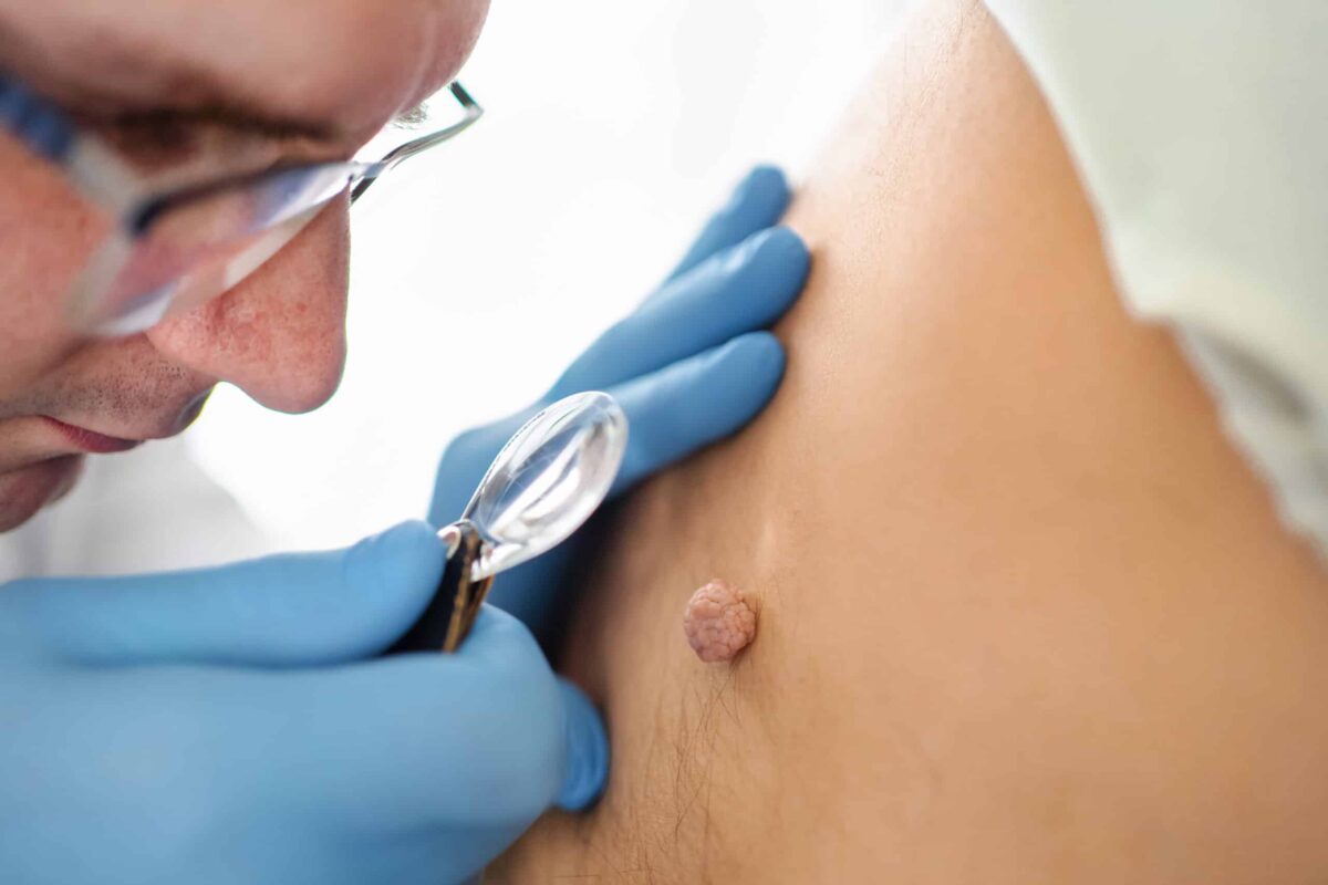 Medical professional inspects skin growth in a clinical setting.