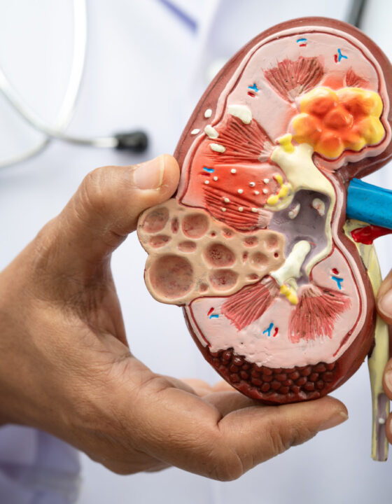 Kidney disease, Chronic kidney disease ckd, Doctor hold human model.